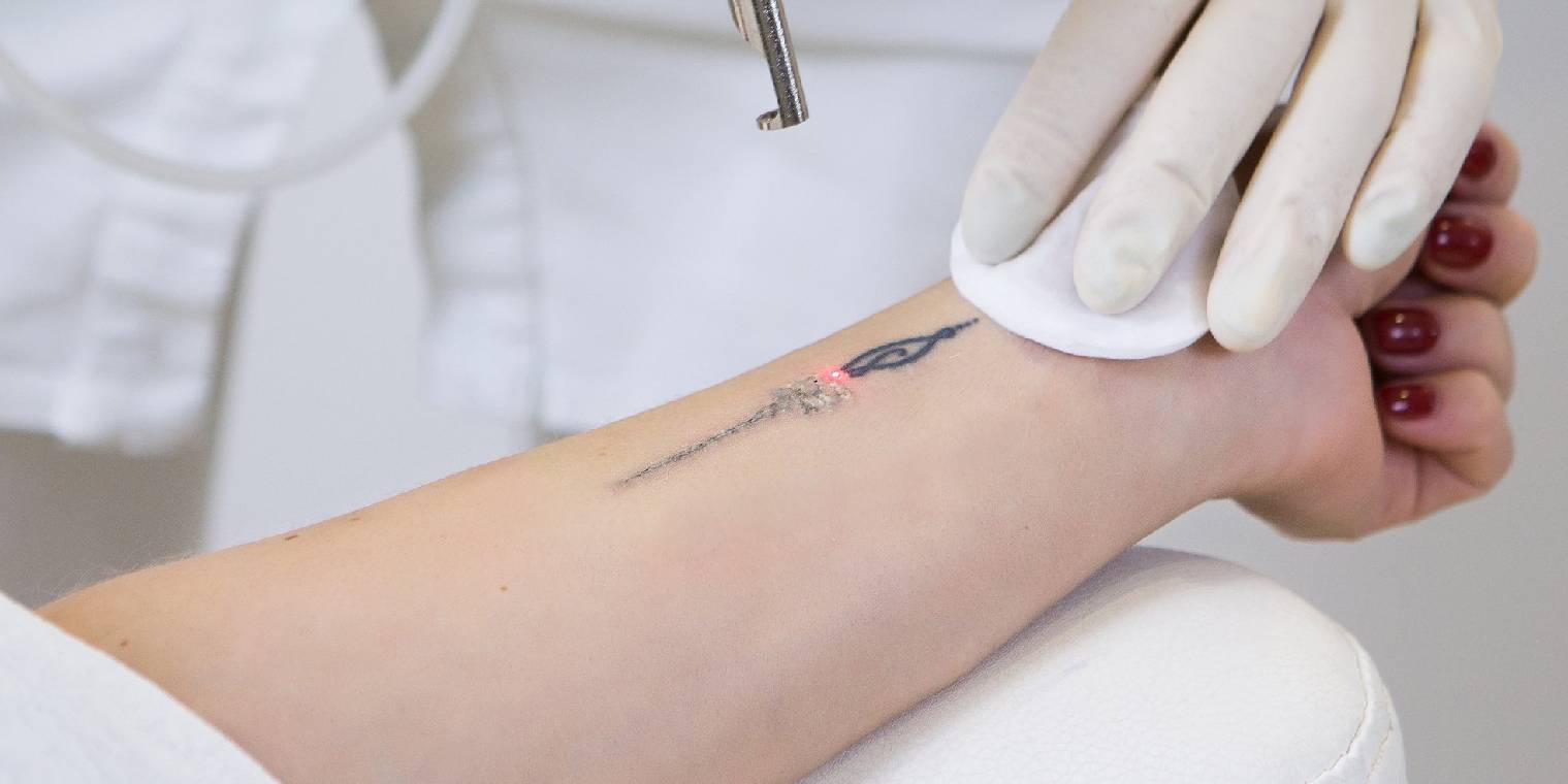 tattoo removal (ND Yag Laser)