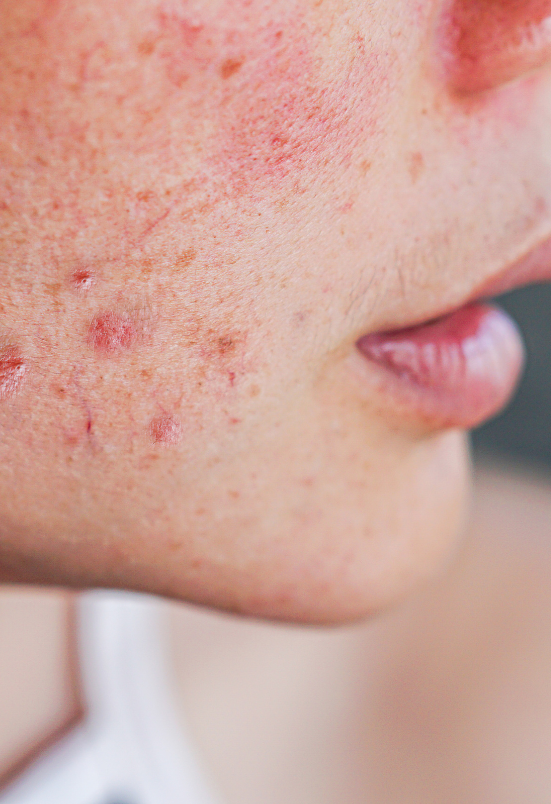 acne scar treatment