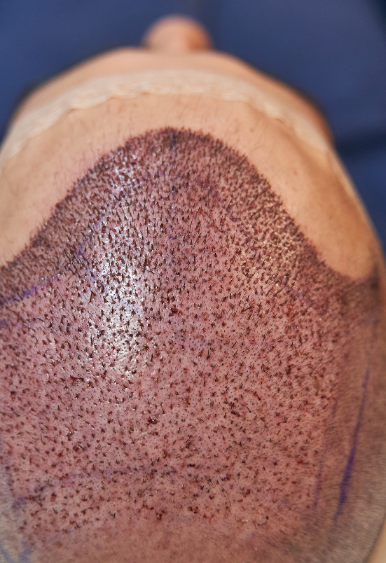 hair transplant in Rohini Delhi