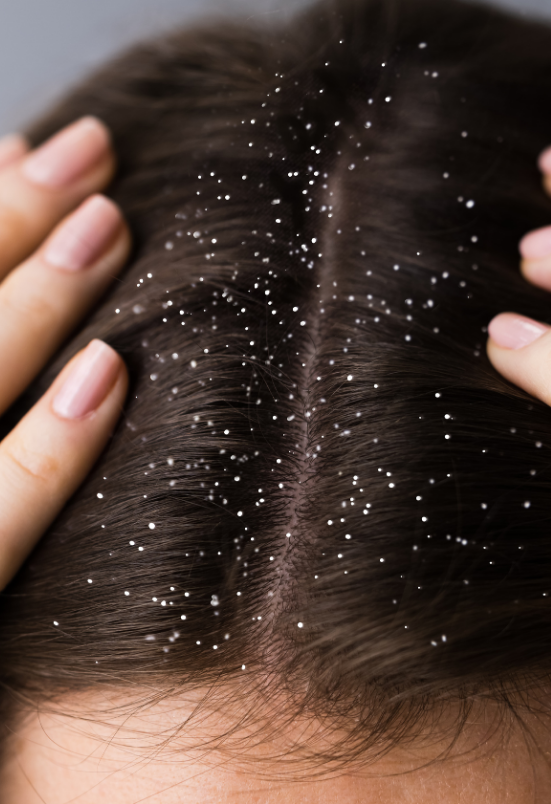 dandruff treatment in Rohini Delhi