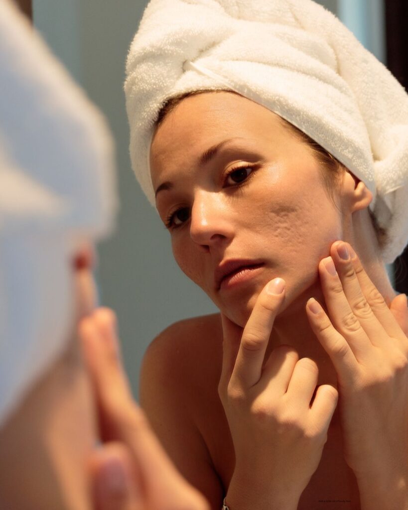 Acne scar prevention and treatment advice by Oswal Jain dermatologist in Rohini