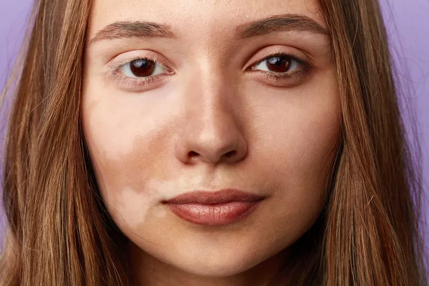 skin pigmentation treatment Rohini