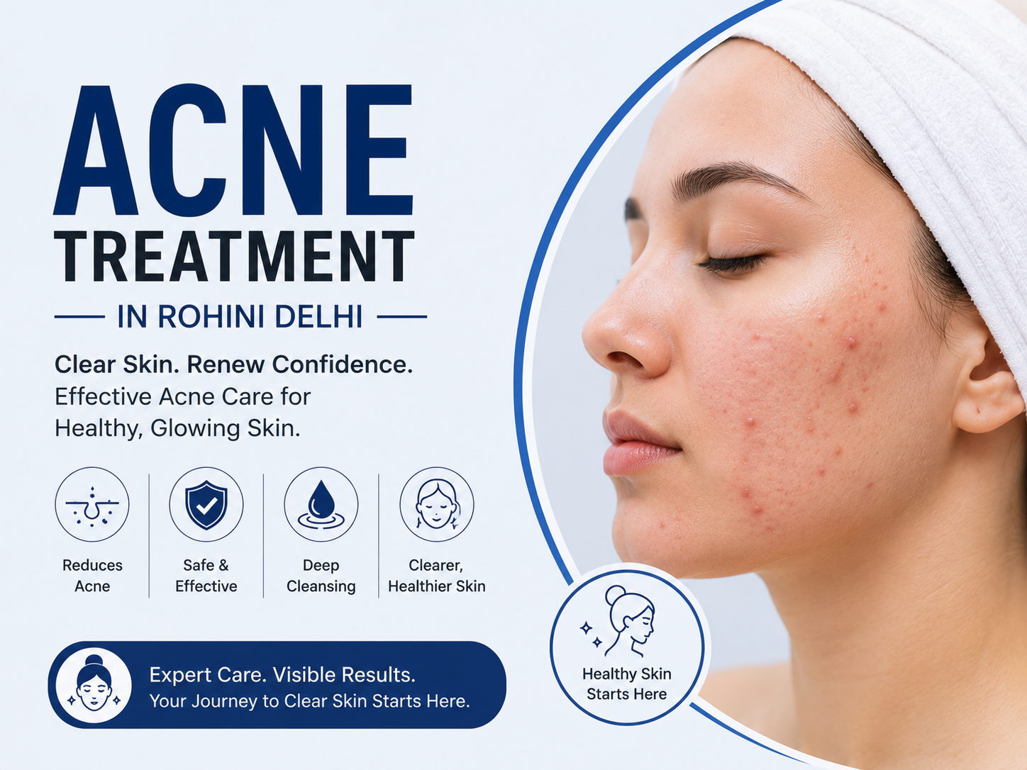 Acne treatment in Rohini Delhi for recurring breakouts