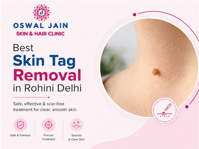 Best Skin Tag Removal in Rohini Delhi by Dr. Varun Jain at Oswal Jain Skin & Hair Clinic
