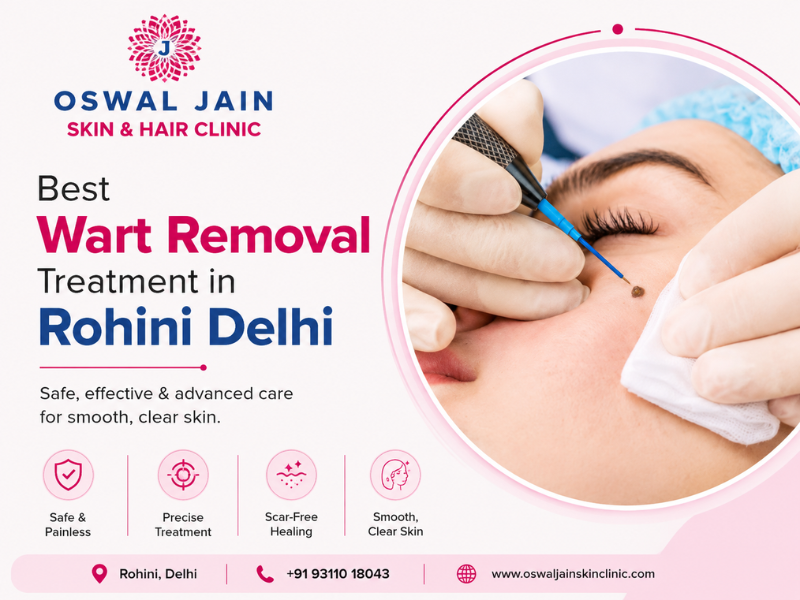 Wart Removal Treatment Rohini