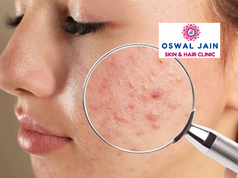 acne treatment