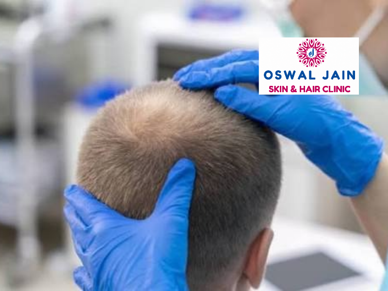 hair fall diagnosis