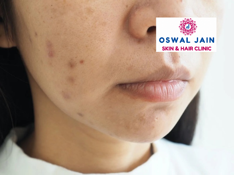 post-acne pigmentation